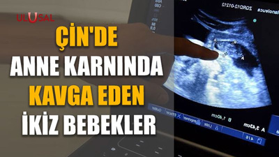 Çin'de anne karnında kavga eden ikiz bebekler